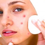 Can Laxative Abuse Cause Acne